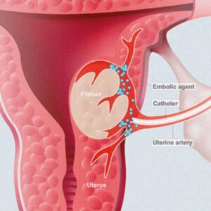 fibroid uterine artery embolization