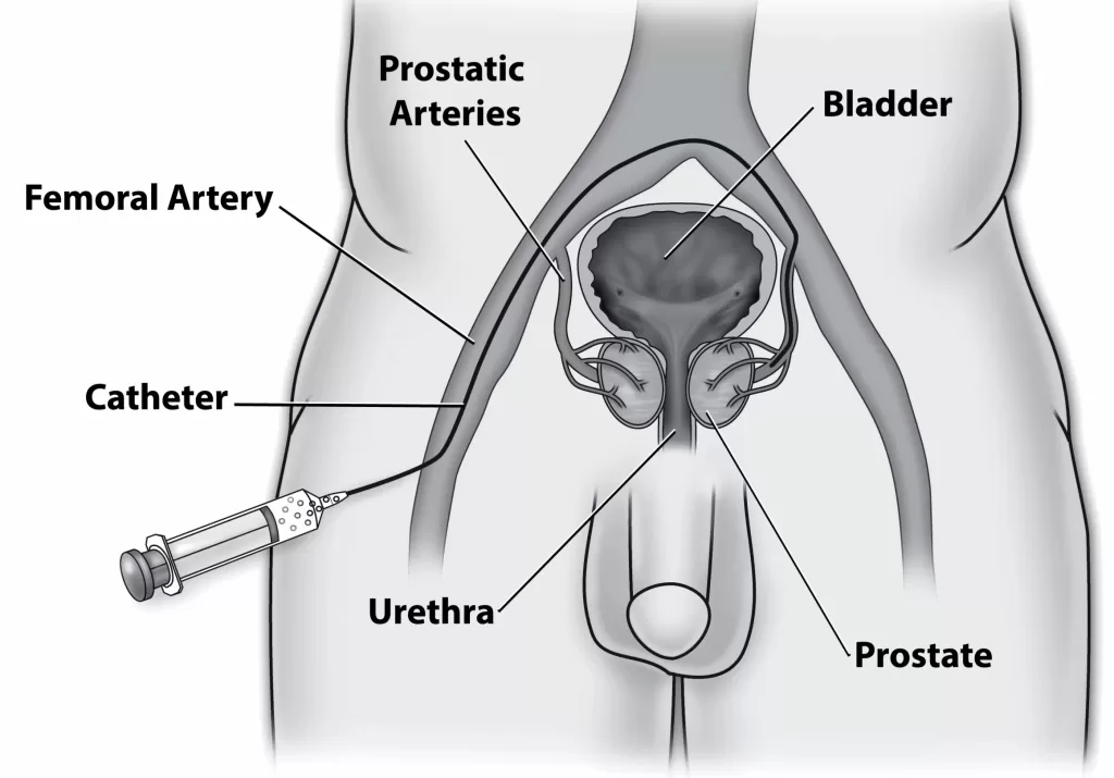 catheter for prostate artery embolization pae