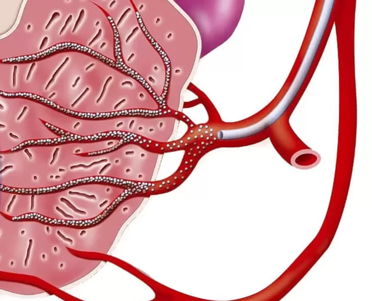 pae beads embolics prostate artery embolization